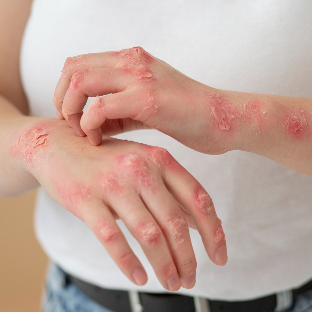 Psoriasis vs Eczema